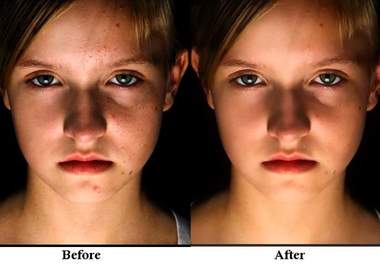 remove acne, scars and other skin impurities from your picture using Photoshop big2
