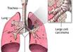 Lung-cancer