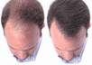 show to how to get rid of Hair fall in three easy steps small1